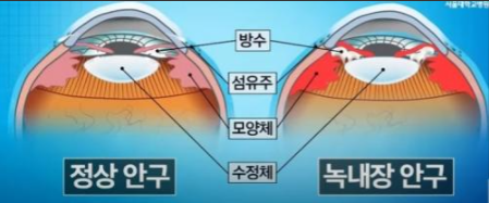 [강남역 녹내장] 소리 없는 시력 도둑, 의학적 가이드라인에 따른 녹내장 치료 방법 총정리 (약물/레이저/수술)