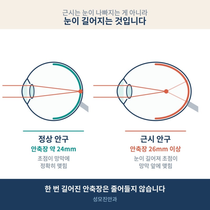 아이 시력 0.7 나왔다면? 초등학생 근시, 안경보다 먼저 확인할 것 사진 3