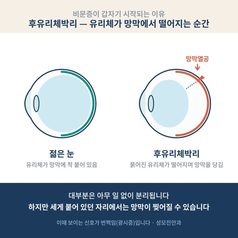 눈앞에 날파리가 떠다닌다면? 그냥 둬도 되는 비문증 vs 당장 안과 갈 신호 사진 3