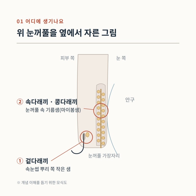 아이 눈에 다래끼, 짜면 안 되는 이유 — 기다려도 되는 경우와 병원에 와야 하는 경우