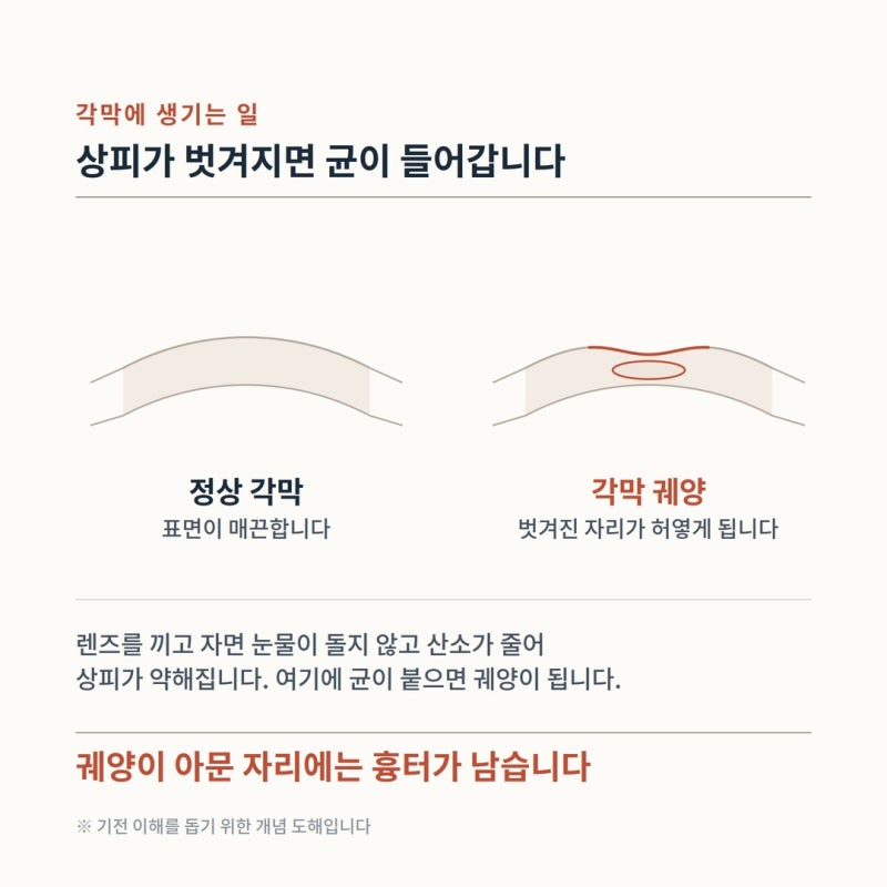 콘택트렌즈 끼고 잠들었다면 — 각막염 경고 증상과 바로 병원에 와야 하는 기준 사진 4