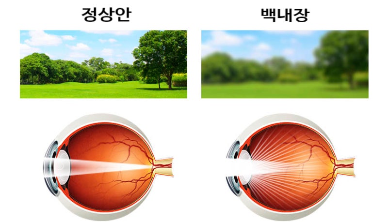 백내장과 노안이란?[안과 외래교수가 들려주는 의학지식]